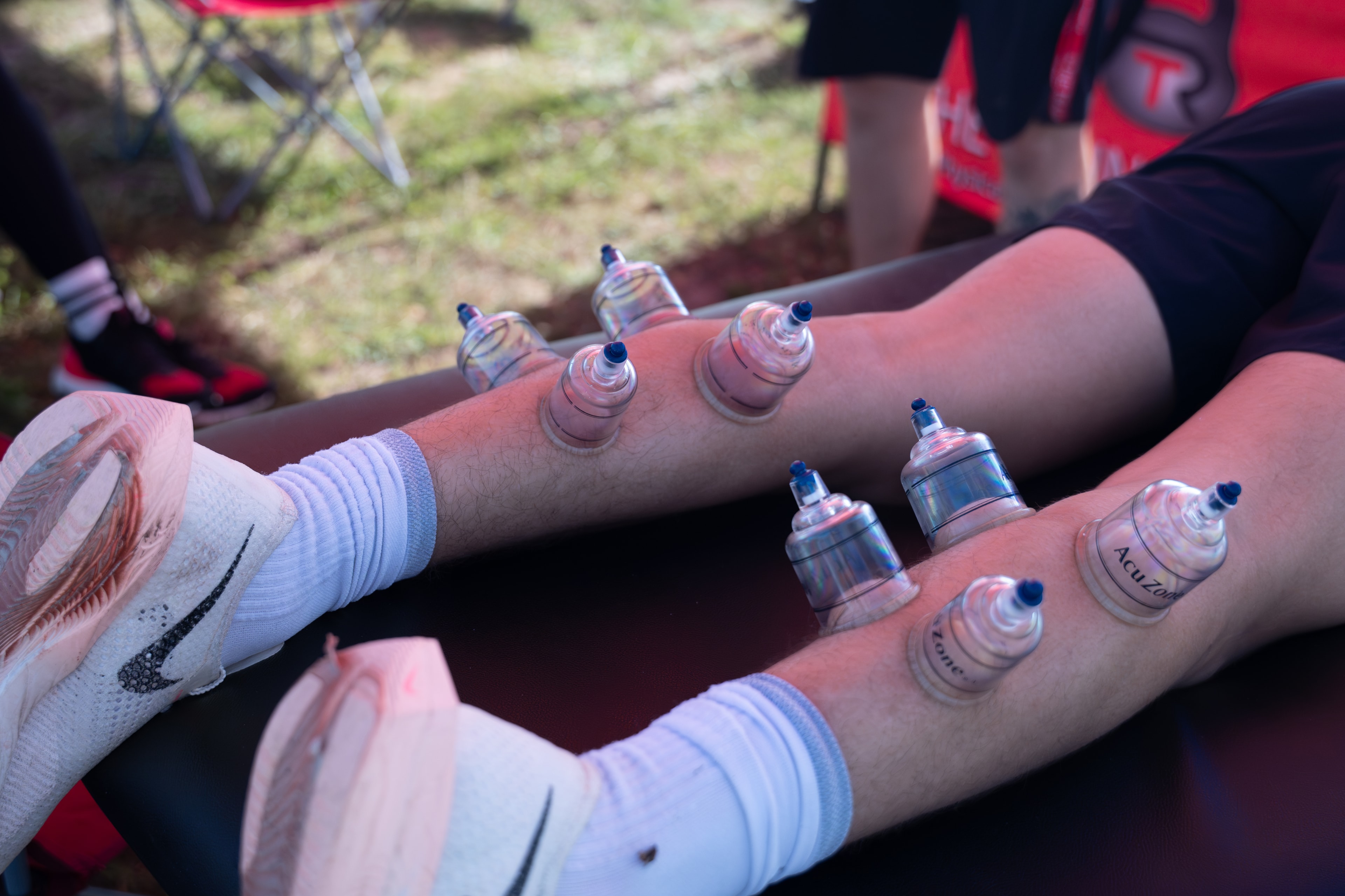 Cupping Therapy