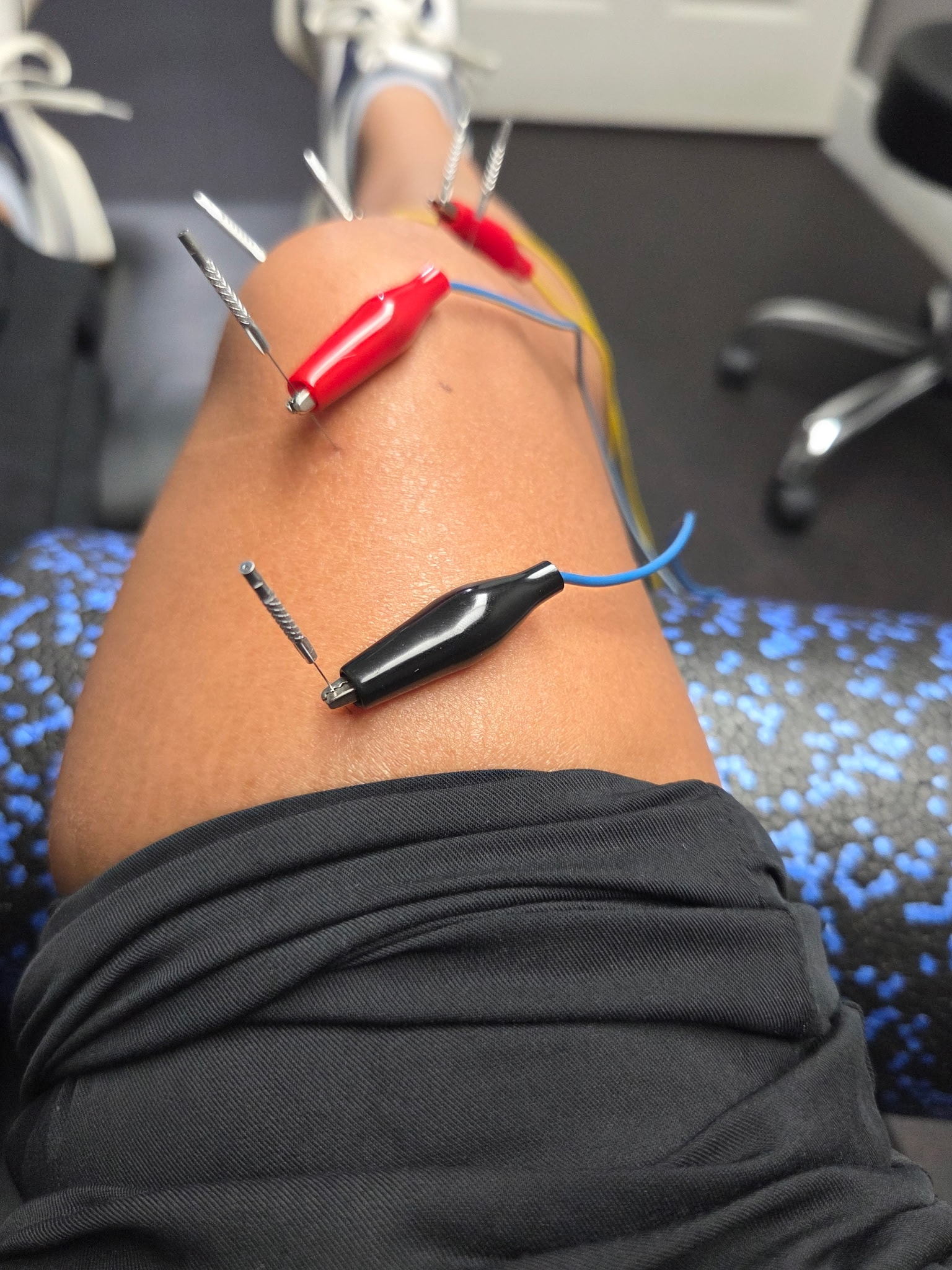 Dry Needling